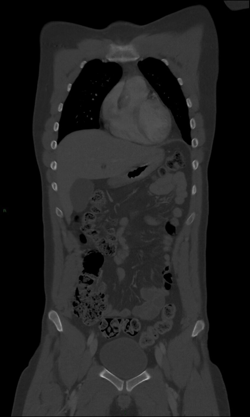 Burst fracture (Radiopaedia 83168-97542 Coronal bone window 23).jpg