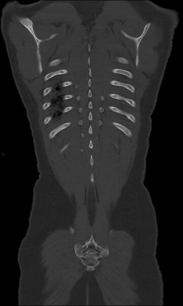 File:Burst fracture (Radiopaedia 83168-97542 Coronal bone window 64).jpg