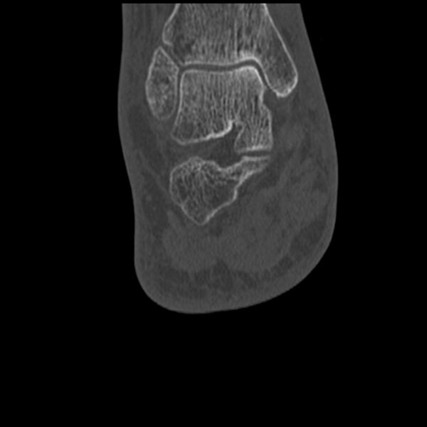 File:Calcaneal tuberosity avulsion fracture (Radiopaedia 22649-22668 Coronal bone window 49).jpg