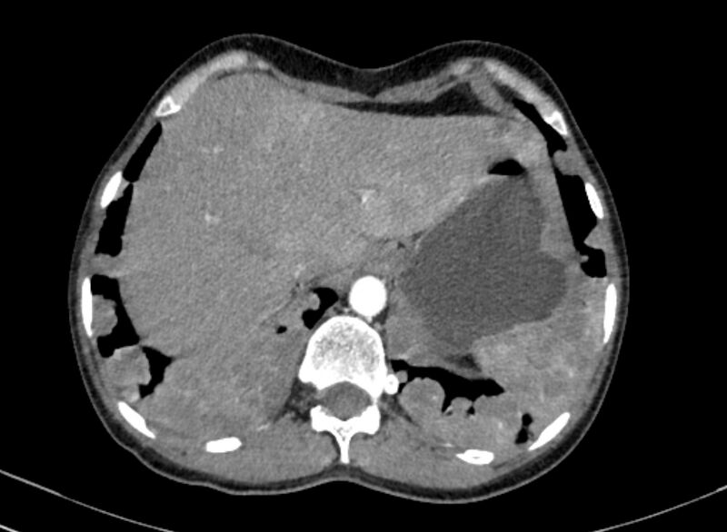 File:Cannonball metastases from breast cancer (Radiopaedia 91024-108569 A 107).jpg