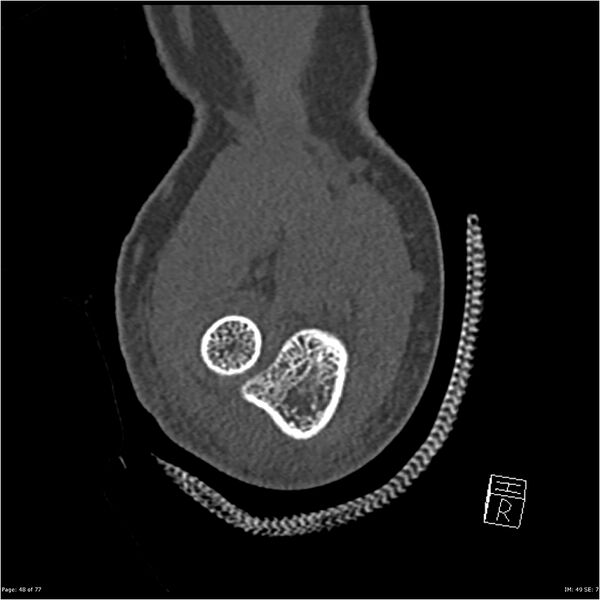 File:Capitellum fracture (Radiopaedia 23352-23426 Coronal bone window 48).jpg