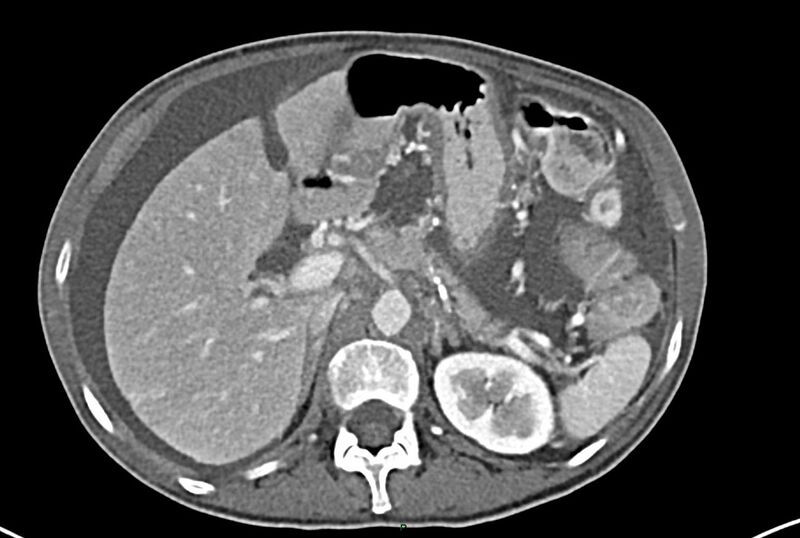 File:Carcinoid mesenteric tumor complicated by chylous ascites (Radiopaedia 76312-87953 A 20).jpg
