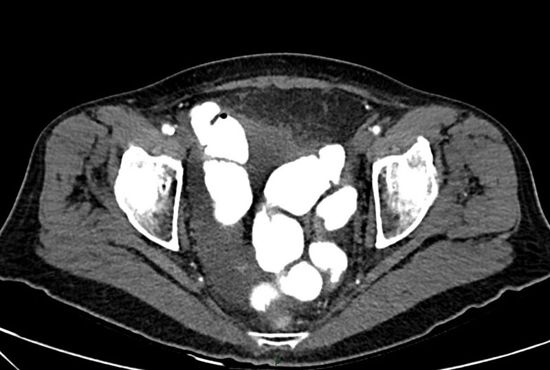 File:Carcinoid mesenteric tumor complicated by chylous ascites (Radiopaedia 76312-88926 A 68).jpg