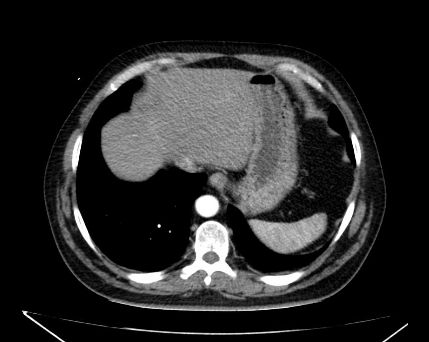Carcinoid tumor with hepatic metastases (Radiopaedia 22651-22670 B 11).jpg