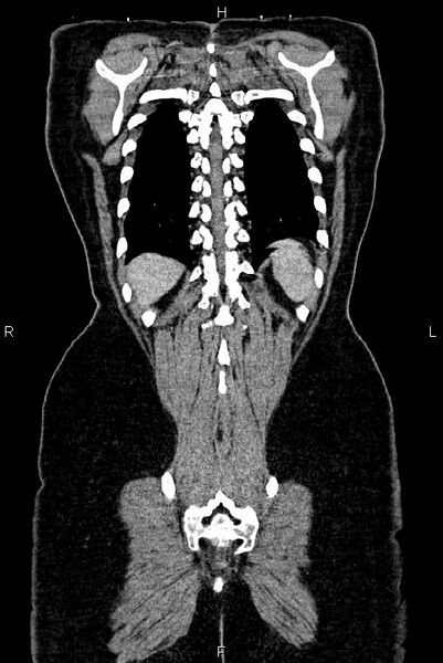 File:Carcinoma of uterine cervix (Radiopaedia 85861-101700 C 52).jpg