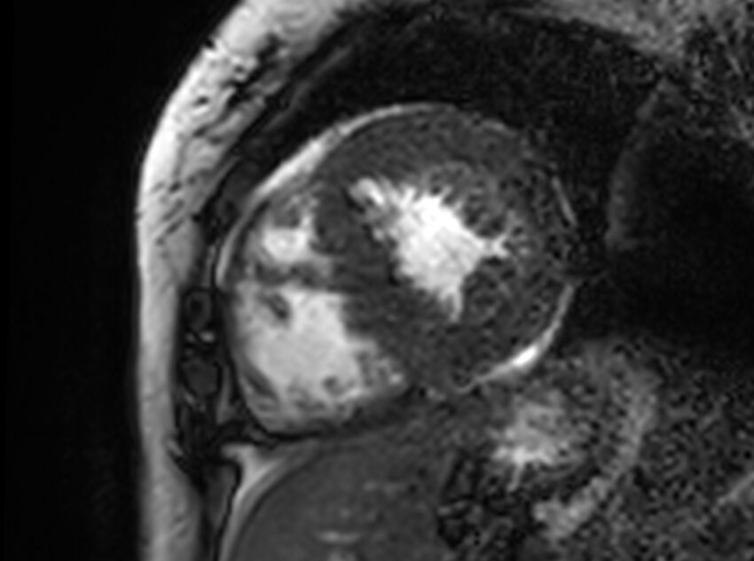 Cardiac amyloidosis (Radiopaedia 61600-69579 Short axis bSSFP 150).jpg