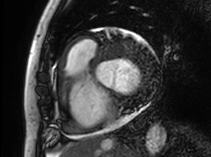 Cardiac amyloidosis (Radiopaedia 61600-69579 Short axis bSSFP 291).jpg