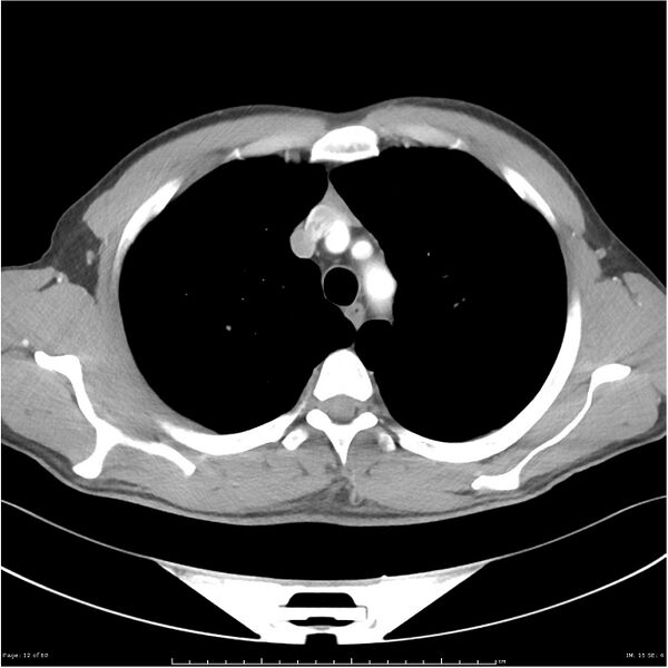 File:Cavitating lung cancer (Radiopaedia 25796-25945 C+ arterial phase 12).jpg