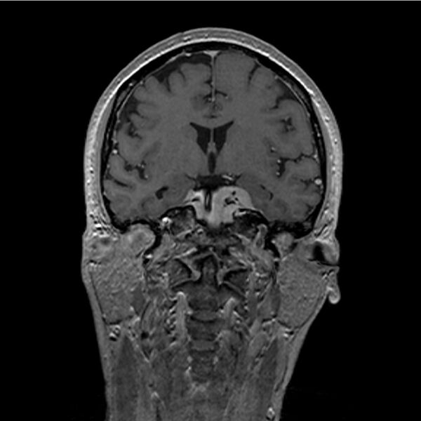 File:Central base of skull meningioma (Radiopaedia 53531-59549 Coronal T1 C+ 18).jpg