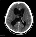 Central neurocytoma (Radiopaedia 4355-6612 Axial C+ delayed 1).jpg