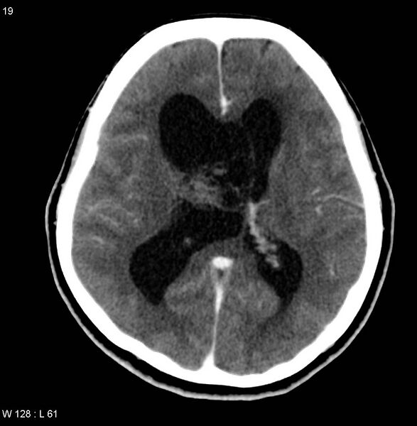 File:Central neurocytoma (Radiopaedia 4355-6612 Axial C+ delayed 1).jpg