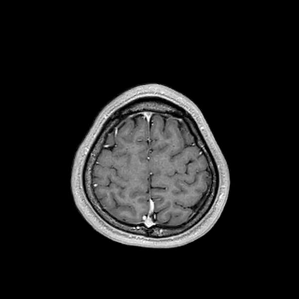 File:Central neurocytoma (Radiopaedia 79320-92380 Axial T1 C+ 200).jpg
