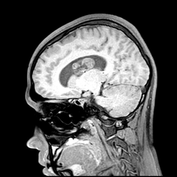 File:Central neurocytoma (Radiopaedia 79320-92380 Sagittal T1 108).jpg