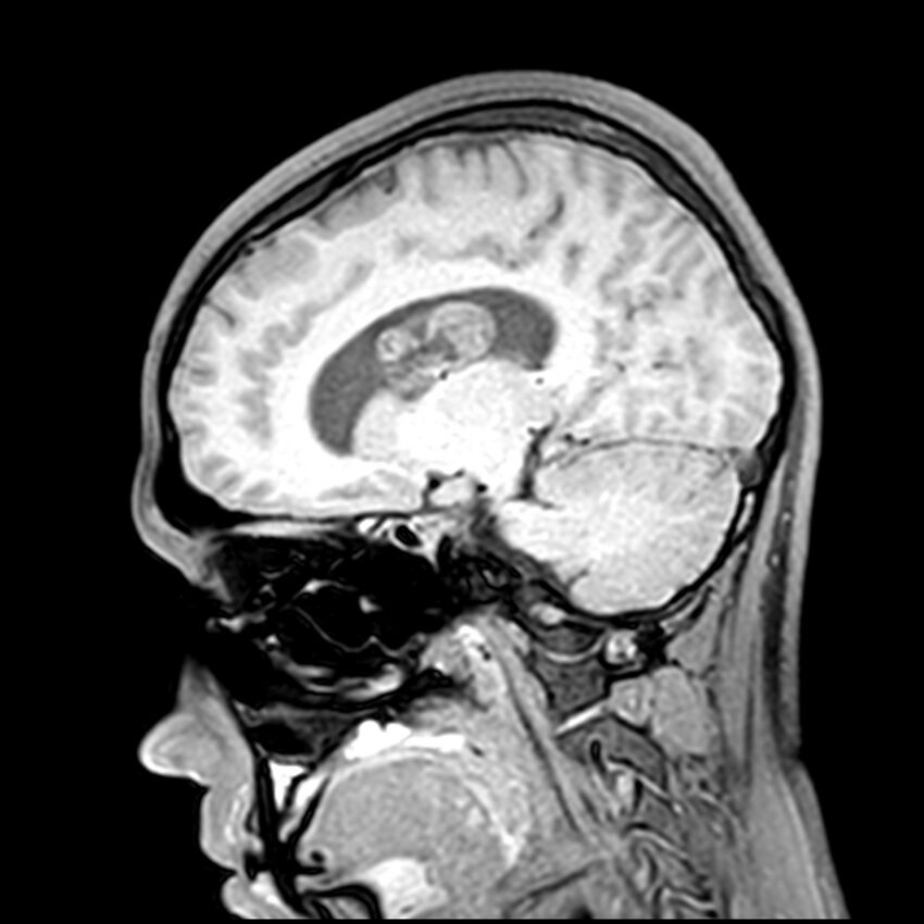 Central neurocytoma (Radiopaedia 79320-92380 Sagittal T1 108).jpg