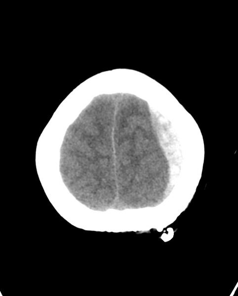 File:Cerebellar ependymoma complicated by post-operative subdural hematoma (Radiopaedia 83322-97737 Axial non-contrast 5).png