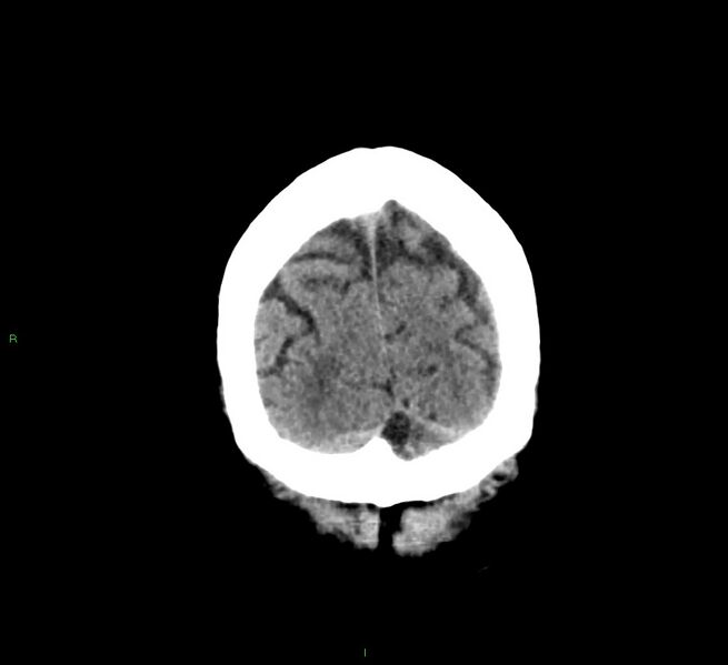 File:Cerebral amyloid angiopathy-associated lobar intracerebral hemorrhage (Radiopaedia 58376-65511 Coronal non-contrast 10).jpg