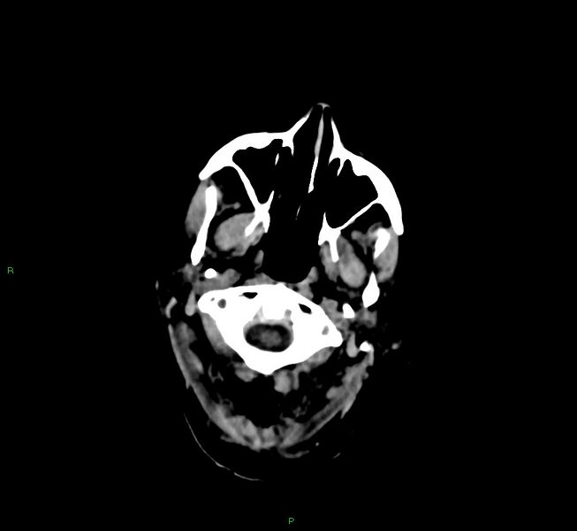 File:Cerebral amyloid angiopathy-associated lobar intracerebral hemorrhage (Radiopaedia 58377-65514 Axial non-contrast 48).jpg