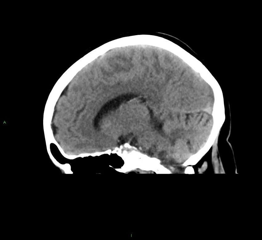 Cerebral amyloid angiopathy-associated lobar intracerebral hemorrhage (Radiopaedia 58378-65516 C 23).jpg