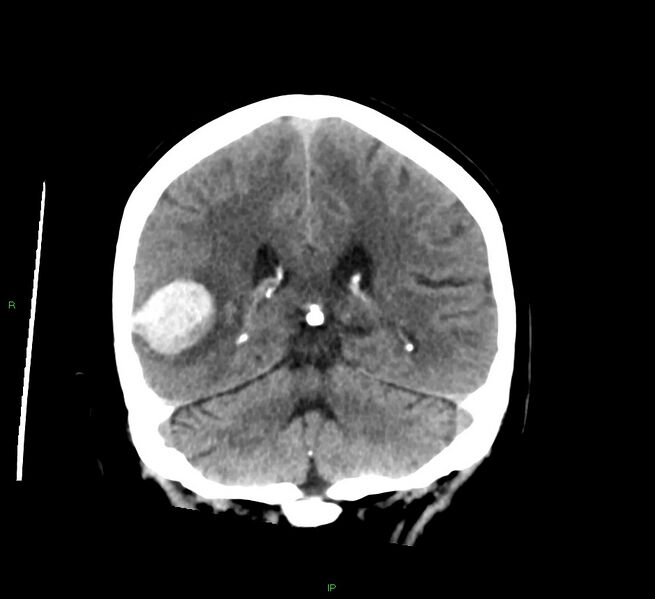 File:Cerebral amyloid angiopathy-associated lobar intracerebral hemorrhage (Radiopaedia 58378-65516 Coronal non-contrast 24).jpg