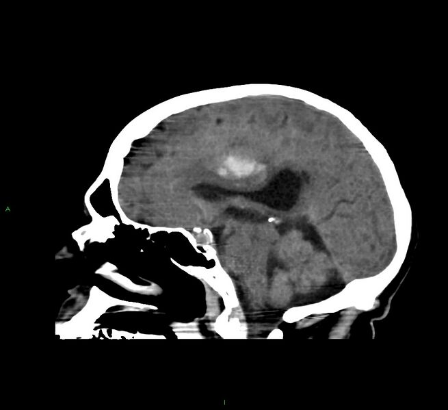 File:Cerebral amyloid angiopathy-associated lobar intracerebral hemorrhage (Radiopaedia 58560-65723 C 28).jpg