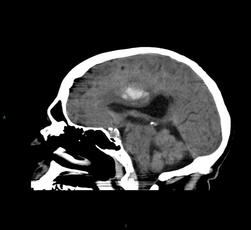 Cerebral amyloid angiopathy-associated lobar intracerebral hemorrhage (Radiopaedia 58560-65723 C 28).jpg