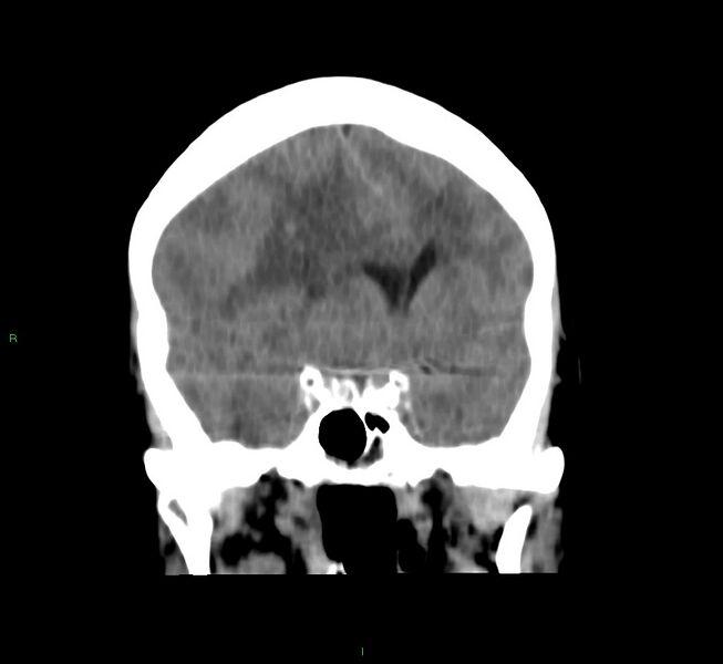 File:Cerebral amyloid angiopathy-associated lobar intracerebral hemorrhage (Radiopaedia 58751-65972 Coronal non-contrast 39).jpg