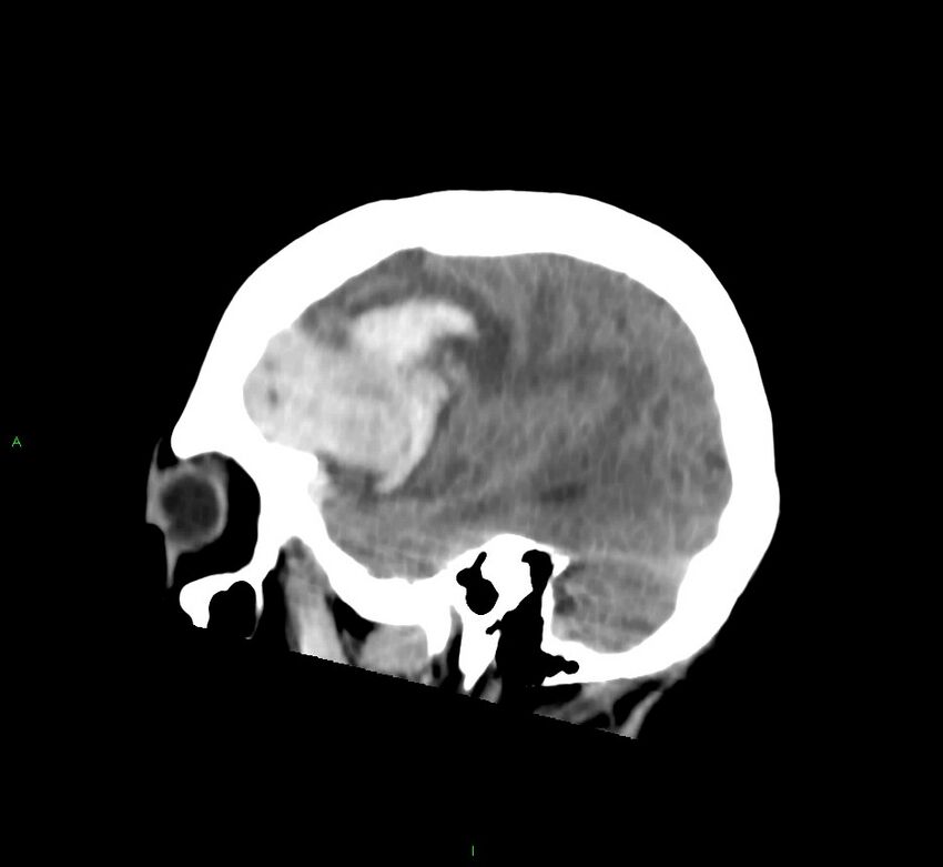 Cerebral amyloid angiopathy-associated lobar intracerebral hemorrhage (Radiopaedia 58752-65973 C 41).jpg