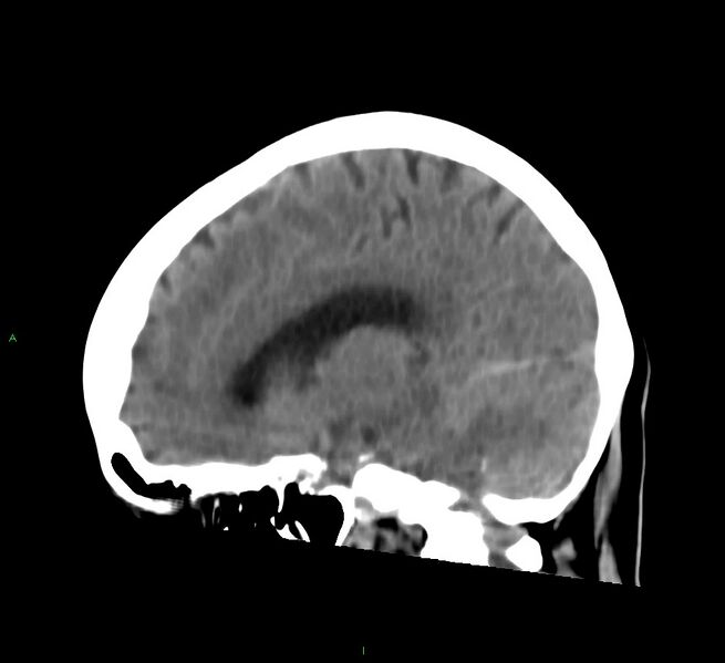 File:Cerebral amyloid angiopathy-associated lobar intracerebral hemorrhage (Radiopaedia 58754-65975 C 20).jpg