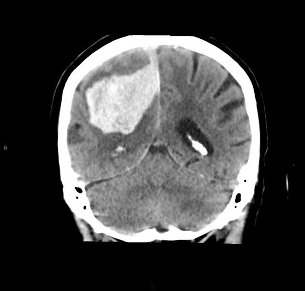 File:Cerebral amyloid angiopathy-associated lobar intracerebral hemorrhage (Radiopaedia 59356-66716 Coronal non-contrast 23).jpg