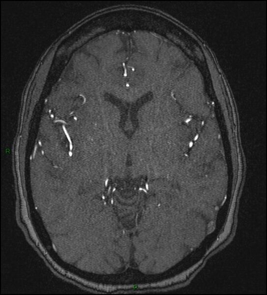 File:Cerebral fat embolism (Radiopaedia 35022-36525 Axial TOF 101).jpg