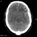 Cerebral hemorrhagic contusion with subdural and subarachnoid hemorrhage (Radiopaedia 10680-11146 Axial non-contrast 10).jpg