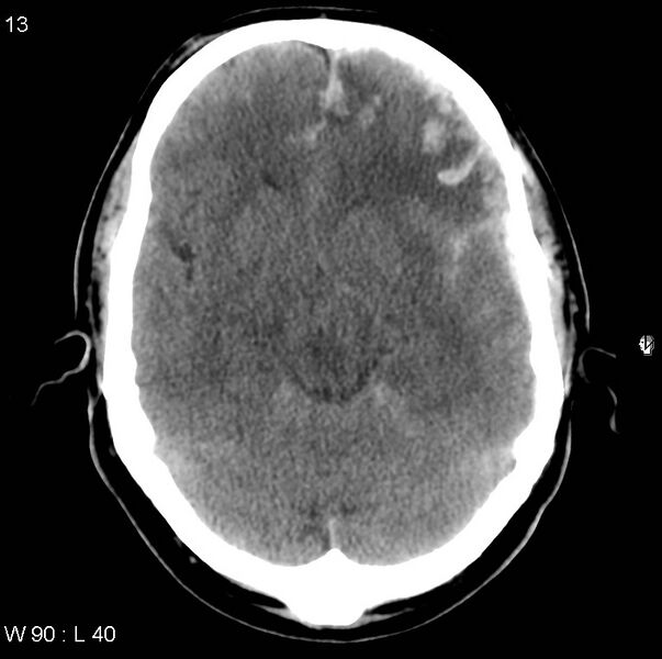 File:Cerebral hemorrhagic contusion with subdural and subarachnoid hemorrhage (Radiopaedia 10680-11146 Axial non-contrast 10).jpg