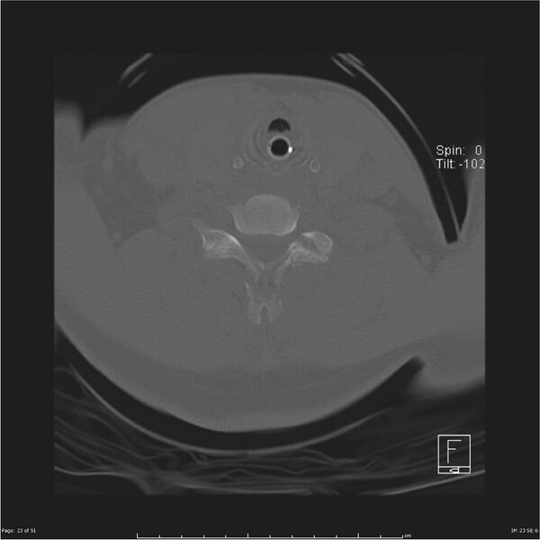 File:Cerebral hemorrhagic contusions and cervical spine fractures (Radiopaedia 32865-33841 C 23).jpg