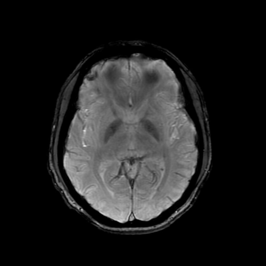 Cerebral paragonimiasis (Radiopaedia 73473-84238 Axial SWI 34).jpg