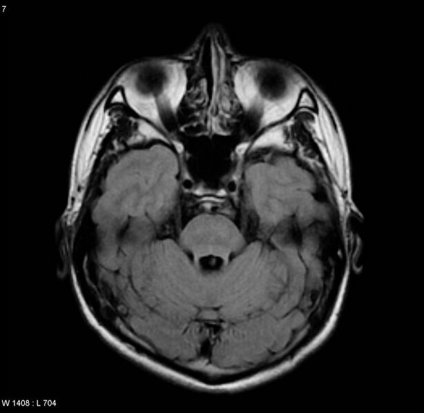 File:Cerebral vasculitis (Radiopaedia 5131-6923 Axial FLAIR 2).jpg