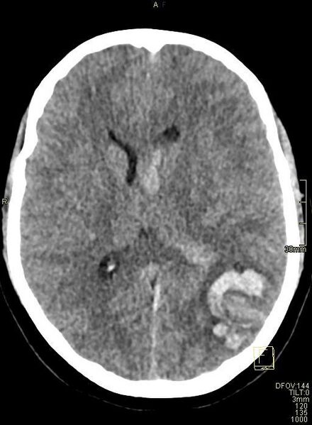 File:Cerebral venous sinus thrombosis (Radiopaedia 91329-108965 Axial non-contrast 28).jpg