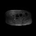 Cervical carcinoma (Radiopaedia 78847-91705 Axial T2 fat sat 4).jpg