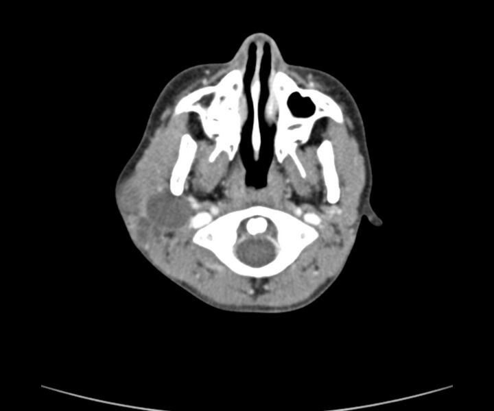 File:Cervical cystic lymphangioma (Radiopaedia 63655-72332 Axial + contrast 6).jpg
