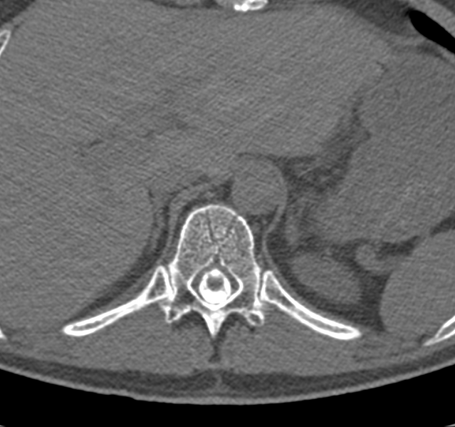 File:Cervical dural CSF leak on MRI and CT treated by blood patch (Radiopaedia 49748-54996 B 79).png