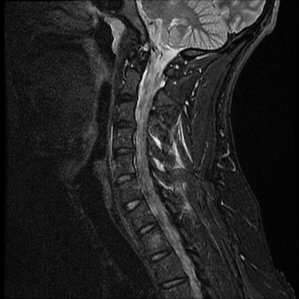 File:Cervical facet fracture and anterior discoligamentous injury (Radiopaedia 32139-33084 Sagittal STIR 6).jpg