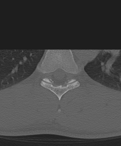 File:Cervical intercalary bone (Radiopaedia 35211-36748 Axial bone window 92).png