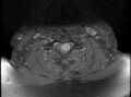 Cervical schwannoma (Radiopaedia 72399-82934 Axial T1 C+ fat sat 12).jpg
