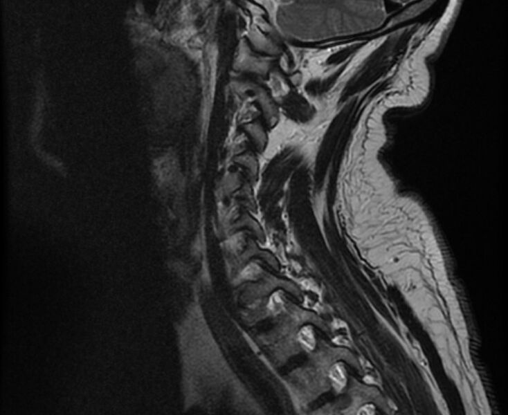 File:Cervical schwannoma (Radiopaedia 72399-82934 Sagittal T2 11).jpg