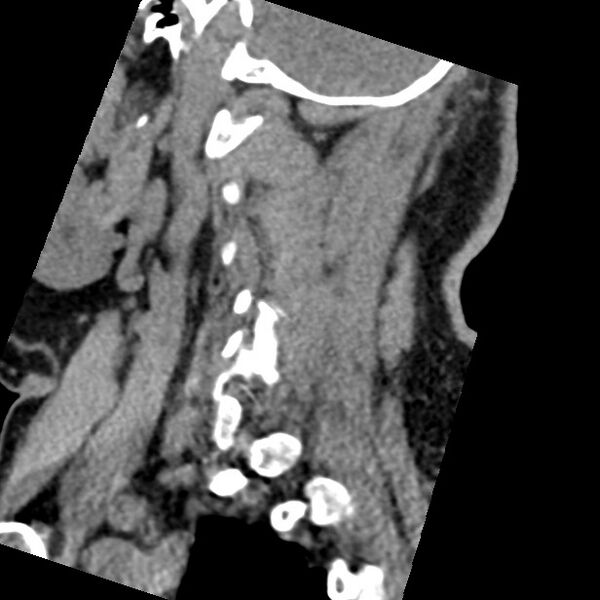 File:Cervical spinal neurofibroma in a patient with NF1 (Radiopaedia 58344-65464 C 42).jpg