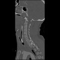 Cervical spine fractures with vertebral artery dissection (Radiopaedia 32135-33078 Sagittal bone window 24).jpg