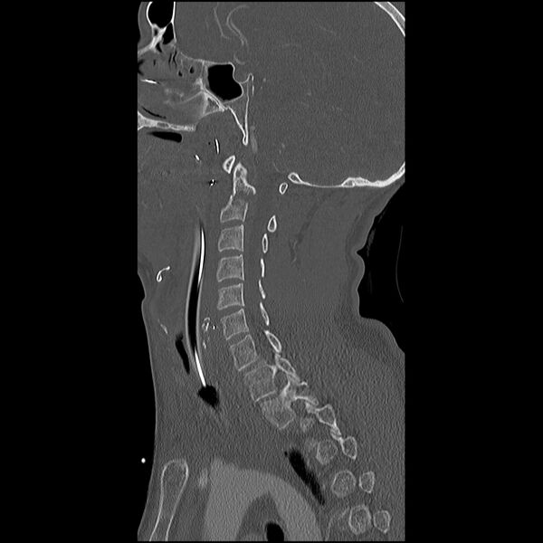 File:Cervical spine fractures with vertebral artery dissection (Radiopaedia 32135-33078 Sagittal bone window 24).jpg