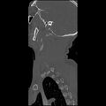 Cervical spine fractures with vertebral artery dissection (Radiopaedia 32135-33078 Sagittal bone window 4).jpg
