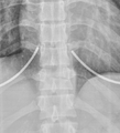 Chance fracture (Radiopaedia 36521-38080 Frontal 1).png