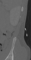 Chance fracture (Radiopaedia 40360-42912 Sagittal bone window 3).png