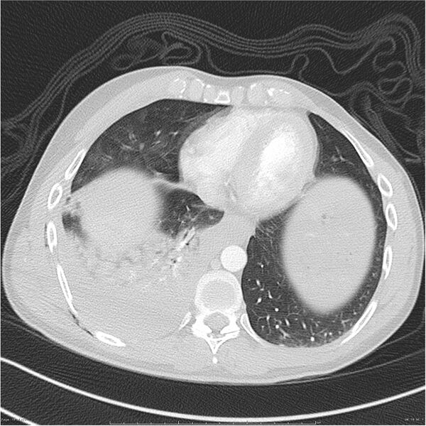 File:Chest and abdomen multi-trauma (Radiopaedia 26294-26425 lung window 78).jpg